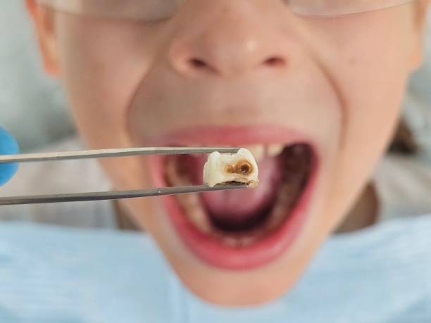 Best Emergency Wisdom Tooth Extraction in Wilson Conococheague, MD